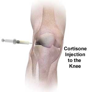 Corticosteroid injection for acne cyst