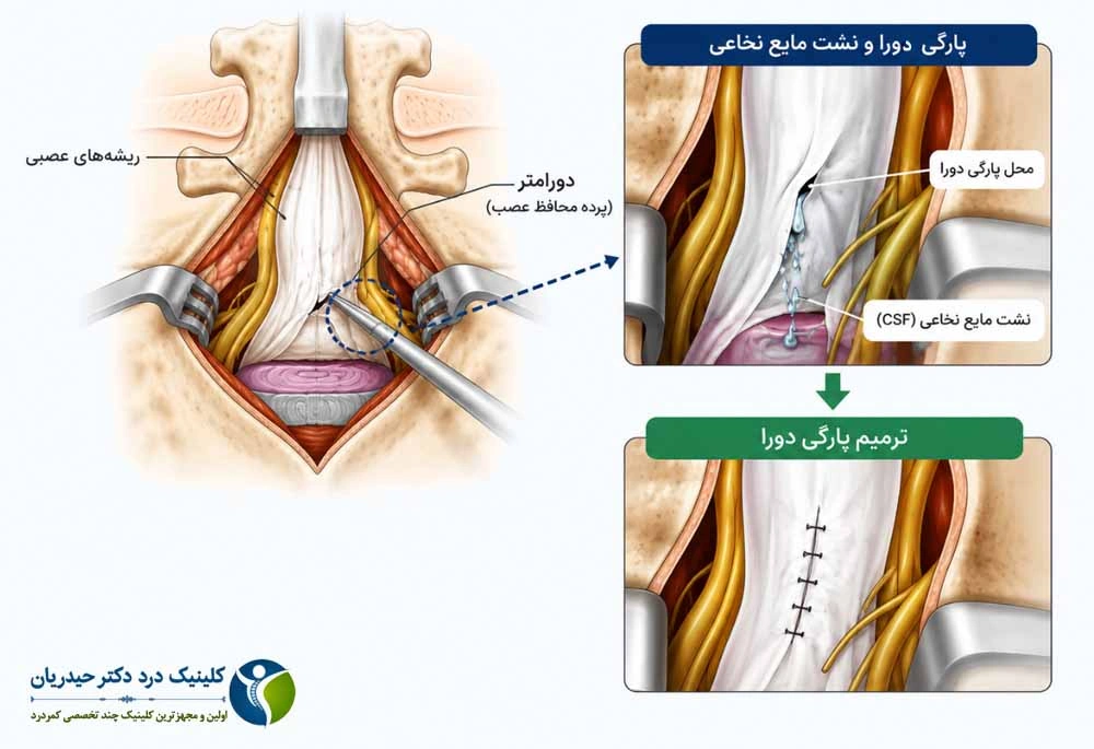 نشت مایع نخاعی