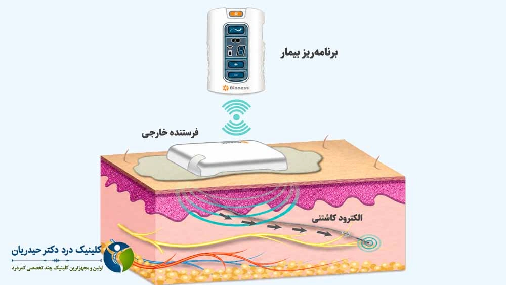 تحریک اعصاب محیطی