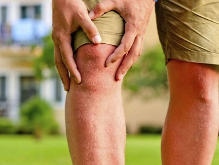 Remedios-naturales-para-los-dolores-de-artritis-1