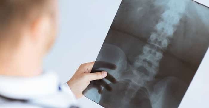 آرتروز ستون فقرات چگونه درمان میشود؟