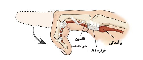 آناتومی-انگشت2-ماشه‌ای