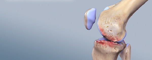 تزریق پی آر پی برای درمان استئو آرتریت مفصل