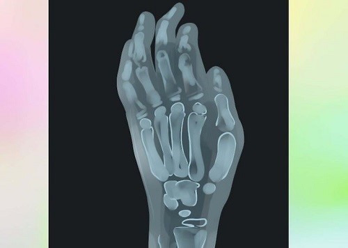 انگشت ماشه‌ای چگونه تشخیص داده می‌شود