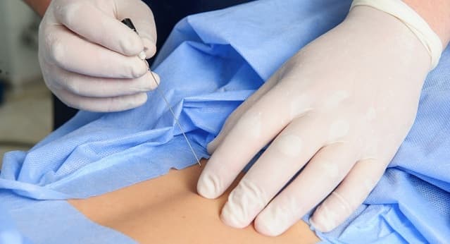 تزریق استروئید برای درمان کمر درد