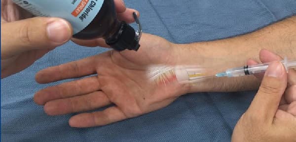 درمان درد ساعد دست با تزریق استروئید