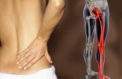 درد سیاتیک