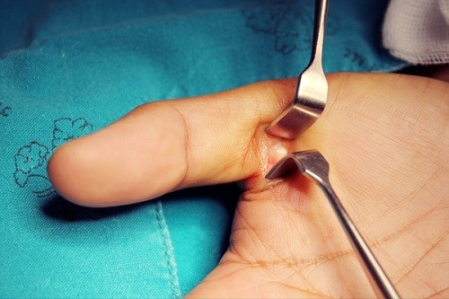 درمان جراحی انگشت ماشه ای