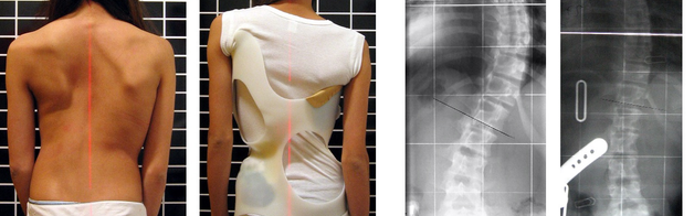 دلایل و انواع قوز کمر