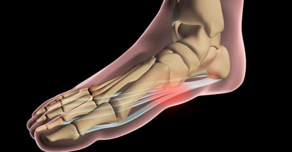 تزریق پی آر پی برای درمان پلانتار فاشیاتیس